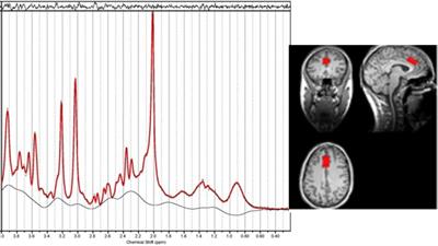 An Investigation of Neurochemical Changes in Chronic Cannabis Users